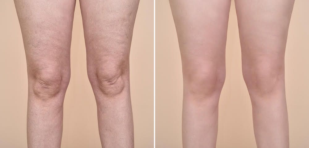 I buchi della tua cellulite hanno i minuti contati: 45 - Guidaestetica.it